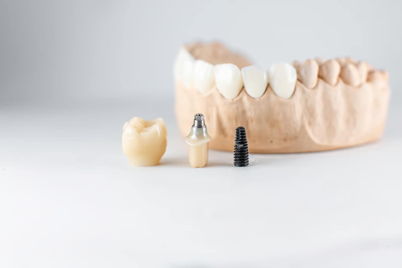 Single Tooth Dental Implants in Boynton Beach, FL