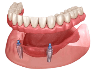 2 Implant Retained Overdenture