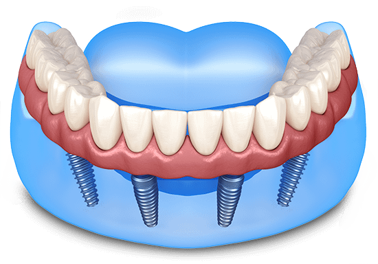 All-On-4 Dental Implants Single Arch