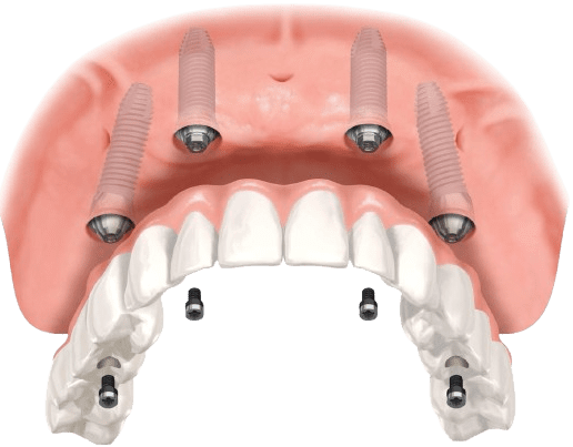Premium Zirconia Restoration - Single Arch