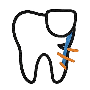 Porcelain Veneers Chips, Gaps, Stains