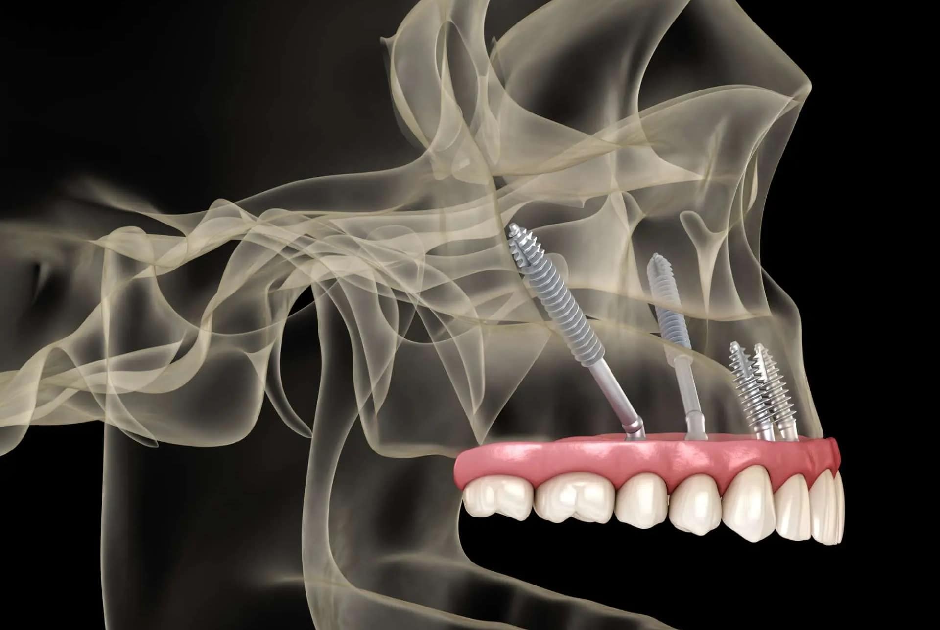 Zygomatic Implants in Boynton Beach, FL
