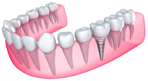 Permanent Zirconia Teeth Double Arch